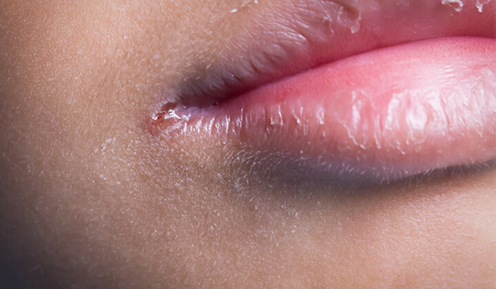 Zu wenig Zink kann der Haut Probleme bereiten 